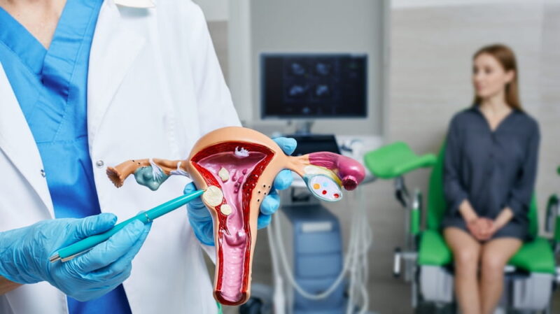 Uterine fibroid, myoma. Gynecologist pointing uterine leiomyomas on anatomical model of uterus